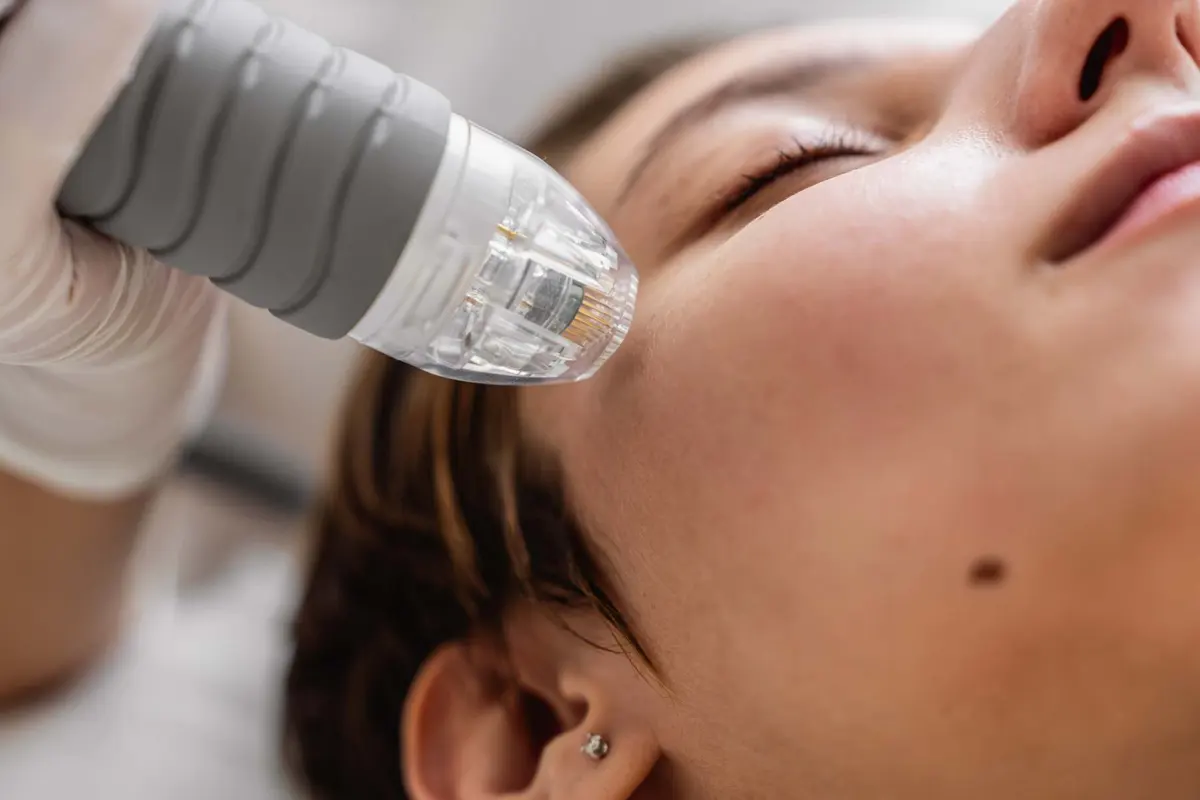 RF microneedling facial skin treatment at Inga's Secrets Aesthetics Northampton