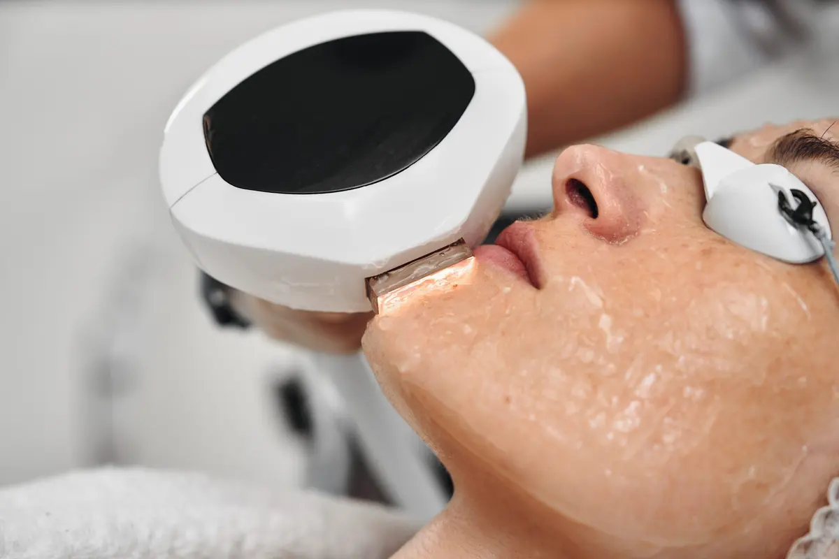 IPL facial vein and pigment removal treatment at Inga's Secrets Aesthetics Northampton